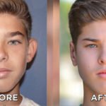 botox-for-teens