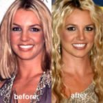 britney-spears-plastic-surgery-and-advanced-lipodissolve