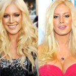 heidi-montag-nose-job-and-plastic-surgery