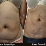 laser-liposuction-smartlipo