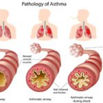 asthma-causes-symptoms-treatment
